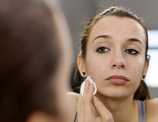 teenager portrait with acne on her face removing makeup with cotton pad.