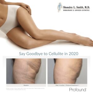 side view of patient’s buttock before and after profound rf microneedling, fewer wrinkles after treatment