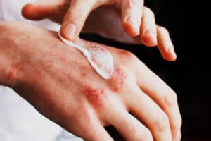 Applying the ointment of eczema psoriasis and other skin diseases