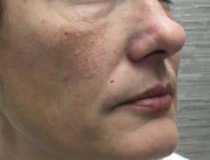 Hyaluronic acid filler to camouflage fat pads under eyes