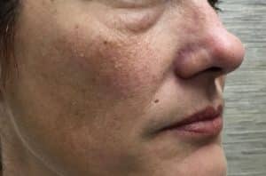 Hyaluronic acid filler to camouflage fat pads under eyes