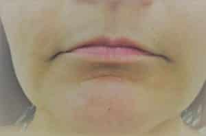 Lip enhancement with Restylane Kysse
