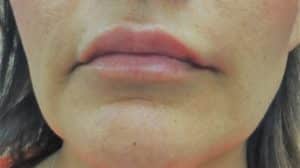 Lip enhancement with Restylane Kysse