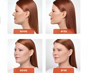 kybella web image 2 (1)