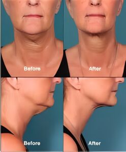 kybella web image 3 248x300 1 (1)