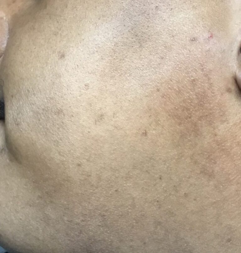 After Image: Chemical Peel for Pigment Removal - front