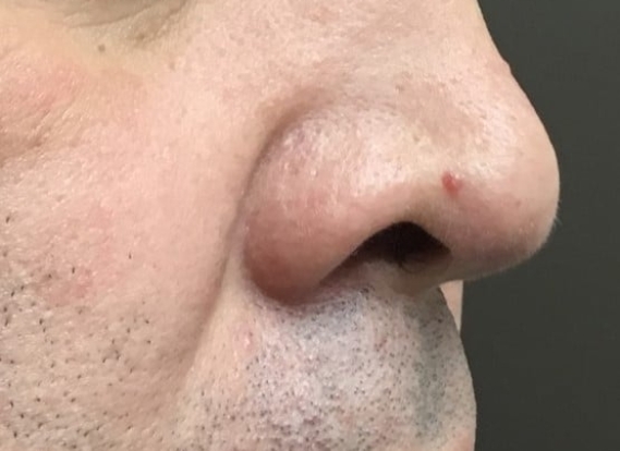 Before Image: Hemangioma Removal - front