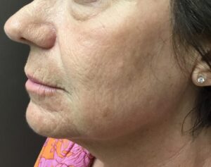 After Image: CO2/Fractional Laser