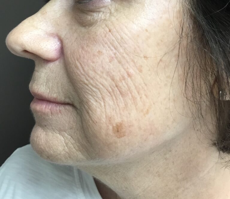 Before Image: CO2/Fractional Laser - front