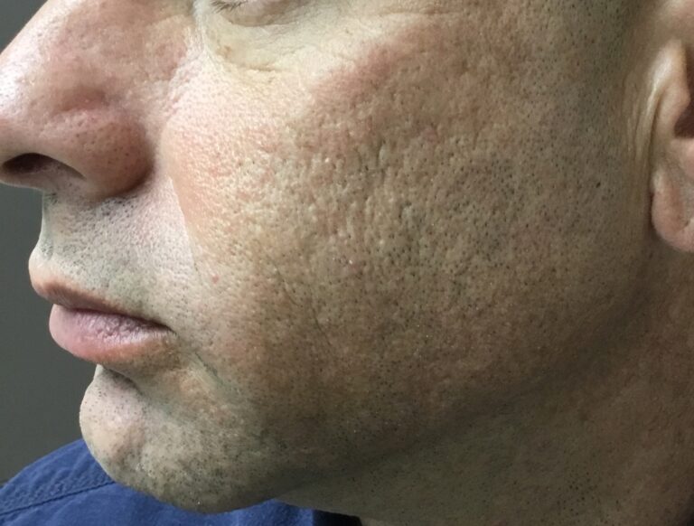 After Image: CO2/Fractional Laser - front