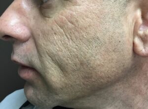 Before Image: CO2/Fractional Laser