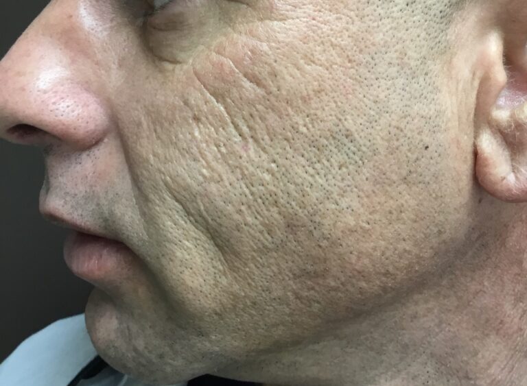 Before Image: CO2/Fractional Laser - front