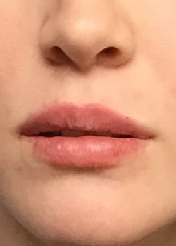 Injectable lip filler