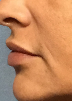 Injectable lip filler