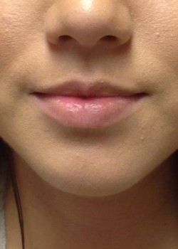 Lip Enhancement Injections