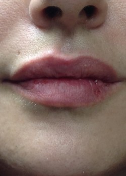 Lip Enhancement Injections
